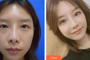 漳州柏思婭醫(yī)療美容門診部李攀整形價(jià)格表附雙眼皮修復(fù)案例案例展示