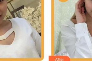 南平時(shí)光醫(yī)療美容門診部趙宏宇整形價(jià)格表附自體脂肪豐胸案例展示