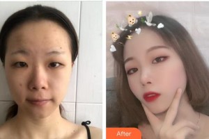 南平時(shí)光醫(yī)療美容門診部廖振浩整形價(jià)格表附埋線提升案例展示