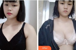 南平時(shí)光醫(yī)療美容門診部侯銳樺整形價(jià)格表附隆胸案例展示