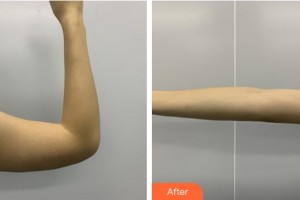 南平時(shí)光醫(yī)療美容門診部金永奎整形價(jià)格表附手臂吸脂案例展示