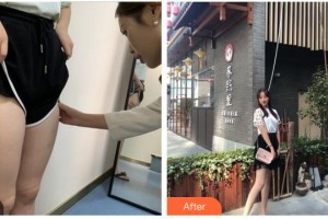 南平時(shí)光醫(yī)療美容門診部周偉整形價(jià)格表附大腿吸脂案例展示