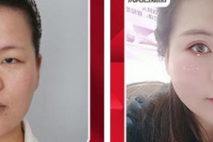 南平華廈眼科醫(yī)院胡甫密整形價(jià)格表附切開(kāi)雙眼皮案例展示