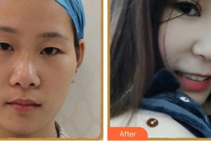 南平華廈眼科醫(yī)院莊永軍整形價(jià)格表附雙眼皮案例展示