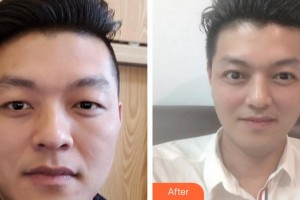 南平武夷厚生眼科醫(yī)院葉荷花整形價(jià)格表附眼部整形案例展示