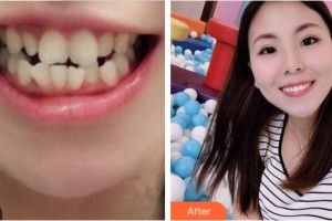 龍巖華美醫(yī)療美容醫(yī)院林永桂整形價(jià)格表附金屬托槽矯正案例展示