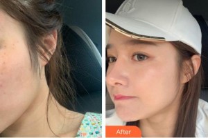 龍巖歐菲醫(yī)療美容門(mén)診部陳玉珠整形價(jià)格表附超激光美膚案例展示