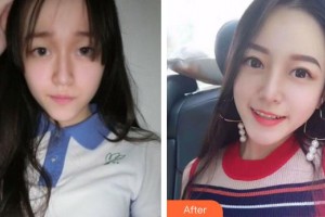 龍巖市第一醫(yī)院燒傷整形醫(yī)療美容科溫裕慶整形價(jià)格表附眼部手術(shù)案例展示