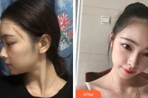 龍巖人民醫(yī)院燒傷整形科林財(cái)輝整形價(jià)格表附疤痕案例展示