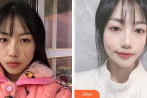 龍巖人民醫(yī)院燒傷整形科林啟雄整形價(jià)格表附疤痕案例展示