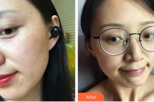 寧德時(shí)代醫(yī)院整形美容科覃建云整形價(jià)格表附超激光美膚案例展示