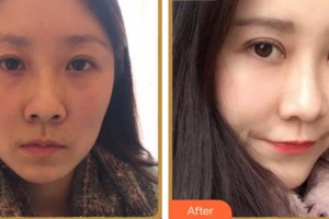 寧德韓美整形美容醫(yī)院黃鑫彬整形價(jià)格表附眼部整形案例展示