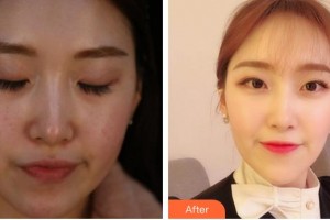 寧德東韓整形美容醫(yī)院熊舒原整形價(jià)格表附超激光美膚案例展示