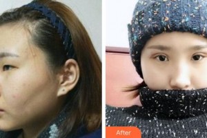 寧德愛爾眼科醫(yī)院劉漢生整形價格表附眼部手術(shù)案例展示