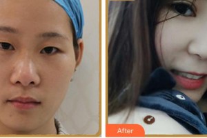 寧德愛爾眼科醫(yī)院郭如汾整形價格表附眼部多項案例展示