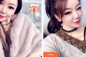 寧德中富口腔醫(yī)院楊登整形價格表附牙齒隱形矯正案例展示