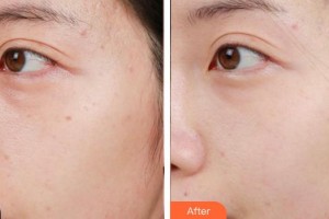 安徽維多利亞整形外科醫(yī)院鐘峰整形價(jià)格表附激光美膚激光祛斑案例展示