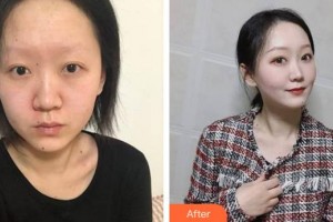 安徽韓美整形美容醫(yī)院吳美珍整形價(jià)格表附面部年輕化案例展示