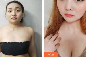 安徽維多利亞整形外科醫(yī)院盛宗順整形價(jià)格表附濃縮豐胸案例展示