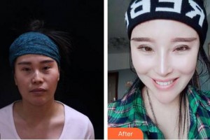 安徽立新醫(yī)學(xué)美容門(mén)診部李戰(zhàn)強(qiáng)整形價(jià)格表附鼻部手術(shù)案例展示