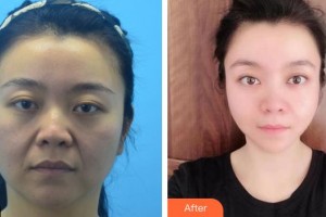 安徽立新醫(yī)學(xué)美容門(mén)診部楊鵬整形價(jià)格表附埋線(xiàn)提升案例展示