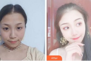 安徽醫(yī)科大學(xué)第二附屬醫(yī)院整形美容中心丁浩整形價(jià)格表附埋線(xiàn)提升案例展示