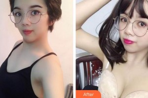 安徽省立醫(yī)院整形燒傷外科王明剛整形價(jià)格表附胸部案例展示