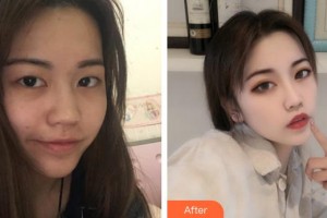 安徽韓美整形美容醫(yī)院葉伊琳整形價(jià)格表附激光美膚激光美白案例展示