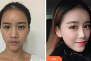 安徽醫(yī)科大學第一附屬醫(yī)院整形美容中心寧金龍整形價格表附鼻部手術案例展示