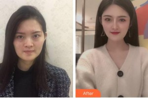 安徽省立醫(yī)院整形燒傷外科余剛整形價格表附半肋軟骨隆鼻案例展示