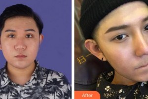 安徽醫(yī)科大學第一附屬醫(yī)院整形美容中心李小靜整形價格表附鼻部整形案例展示