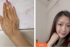 武警安徽總隊醫(yī)院皮膚美容科袁鋒整形價格表附手術(shù)祛疤案例展示