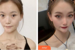 武警安徽總隊醫(yī)院皮膚美容科郭明亮整形價格表附祛疤案例展示