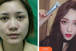 安徽醫(yī)科大學附屬巢湖醫(yī)院燒傷整形科劉安軍整形價格表附鼻部綜合案例展示