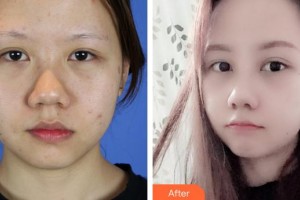 安徽醫(yī)科大學附屬巢湖醫(yī)院燒傷整形科葛禮正整形價格表附鼻部整形案例展示