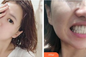 安徽醫(yī)科大學口腔醫(yī)學院王海林整形價格表附隱形托槽矯正案例展示