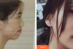 安徽醫(yī)科大學口腔醫(yī)學院徐文華整形價格表附金屬托槽矯正案例展示