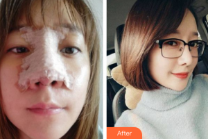 廣州藝美醫(yī)療美容門診部李闖整形價(jià)格表附鼻部手術(shù)案例展示