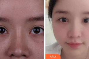 廣州締妍醫(yī)療美容門診部李應(yīng)整形價(jià)格表附眼部整形案例展示