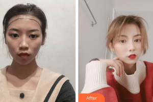 廣州弘基醫(yī)療美容門診部廖莉整形價(jià)格表附植發(fā)案例展示