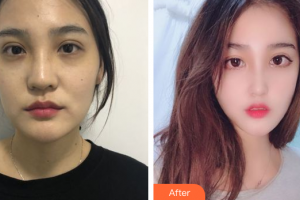 廣州國(guó)姿醫(yī)療美容整形醫(yī)院曾德浩整形價(jià)格表附鼻部手術(shù)案例展示