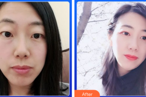 廣州美詩(shī)沁醫(yī)療美容門診部霍建法整形價(jià)格表附眼部整形案例展示