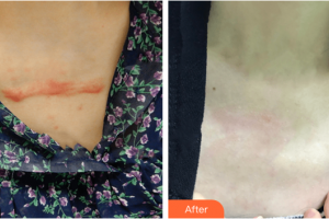 廣州凱美達(dá)整形美容醫(yī)院曾芬整形價(jià)格表附微創(chuàng)疤痕修復(fù)案例展示