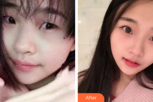 廣州美詩(shī)沁醫(yī)療美容門診部汪生整形價(jià)格表附眼部手術(shù)案例展示