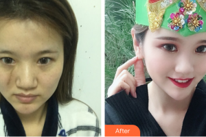 廣州博研醫(yī)療美容門診部劉仲榮整形價(jià)格表附微創(chuàng)疤痕修復(fù)案例展示