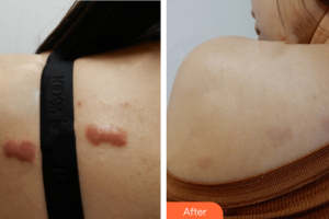 廣州鵬愛醫(yī)療美容門診部付曉焜整形價(jià)格表附微創(chuàng)疤痕修復(fù)案例展示