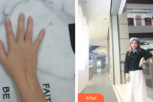 廣州醫(yī)科大學(xué)附屬第一醫(yī)院整形外科朱健整形價(jià)格表附增生疤痕案例展示