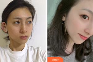 廣州中家醫(yī)家庭醫(yī)生醫(yī)學(xué)整形美容醫(yī)院于國(guó)中整形價(jià)格表附疤痕疙瘩案例展示