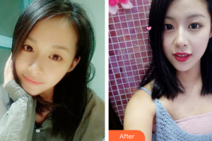 廣州慕美醫(yī)療美容醫(yī)院凌通整形價(jià)格表附精致雙眼皮案例展示