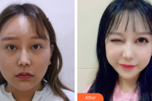 廣州美詩沁醫(yī)療美容門診部馬滿倉整形價格表附雙眼皮+眼瞼下至案例展示